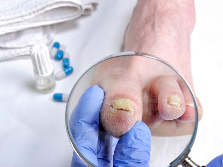 Traitement ongle incarné, Vichy